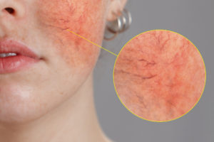 Redness From Rosacea