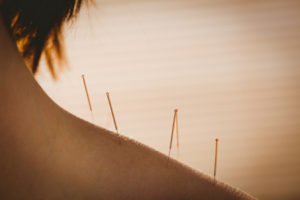 44769827 - young woman getting acupuncture treatment in therapy room